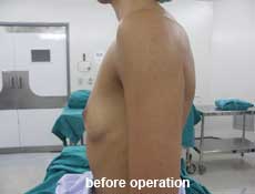 plastic-surgery-breast-augmentation 